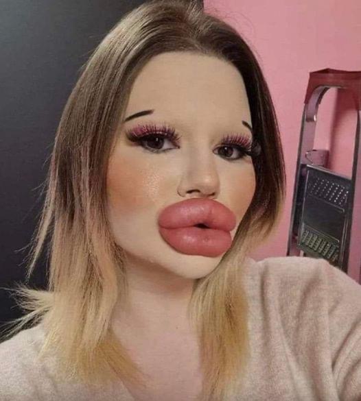 She has the world’s biggest lips, and now wants huge cheekbones to match… You had better sit down before you see how she looked before.